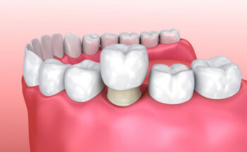 Excent Tandtechniek gaat op in European Dental Group